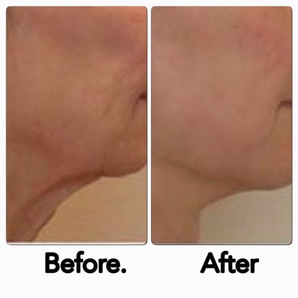 Facelift 8