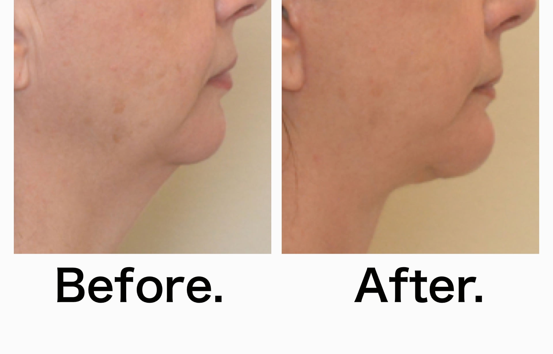 Facelift 10