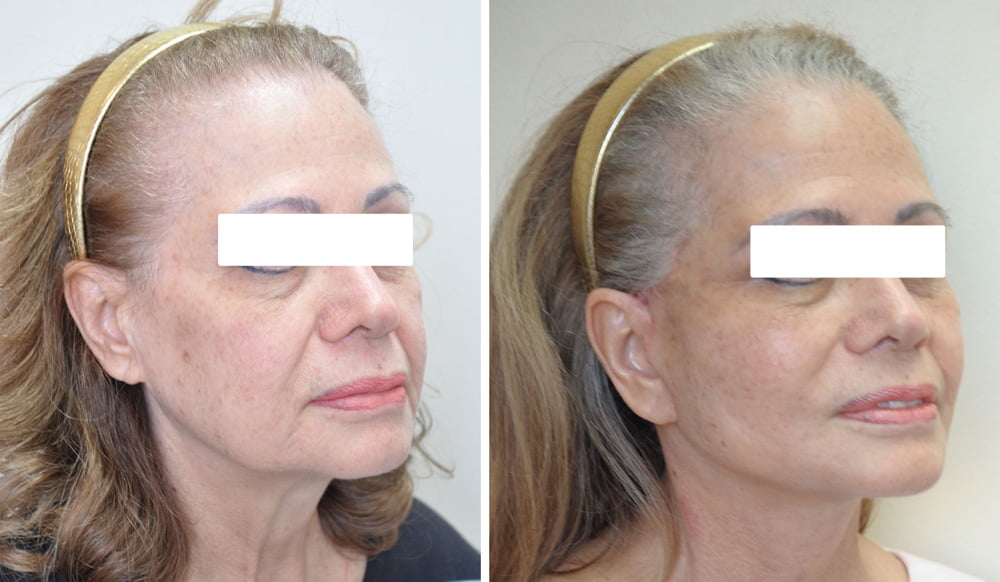 Facelift 2