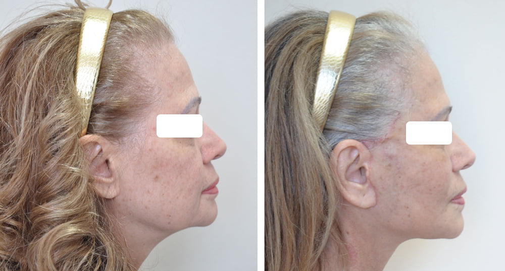 Facelift 3