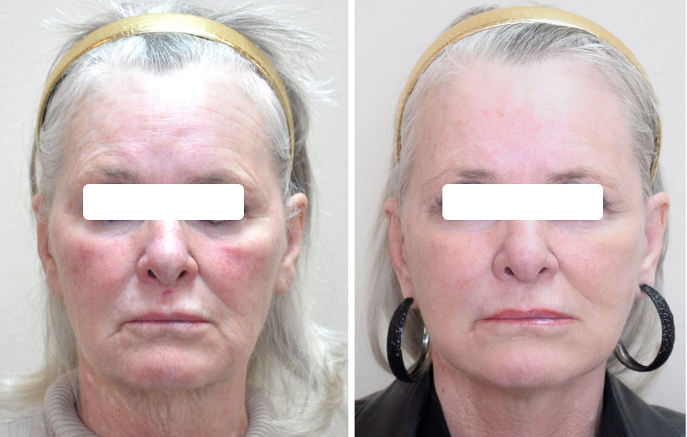 Facelift 4