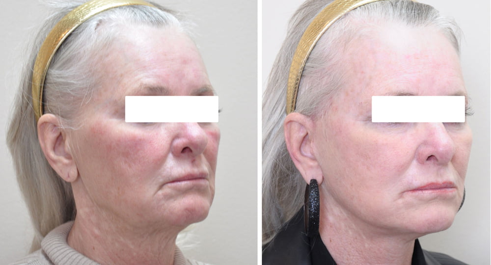 Facelift 5