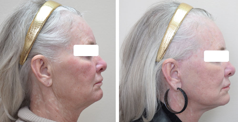 Facelift 6